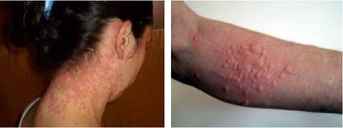 allergie chenilles processionnaires