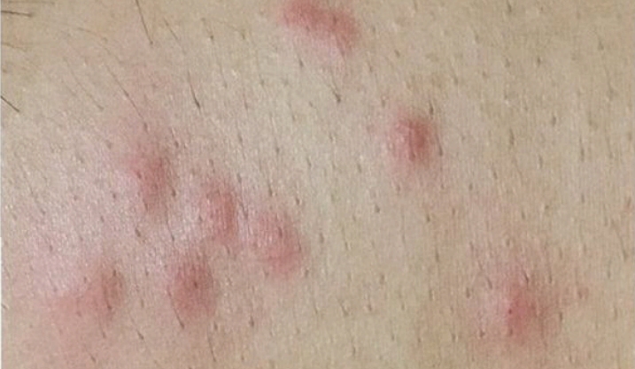 Piqures de punaises de lit
